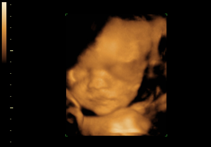 3D ultrasound image at 28 weeks